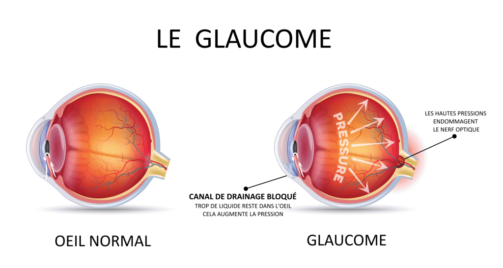 Le traitement du glaucome : comment ça marche ?