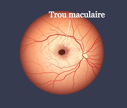 Le trou maculaire : comprendre et traiter
