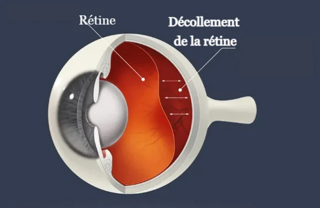 Decollement Retine